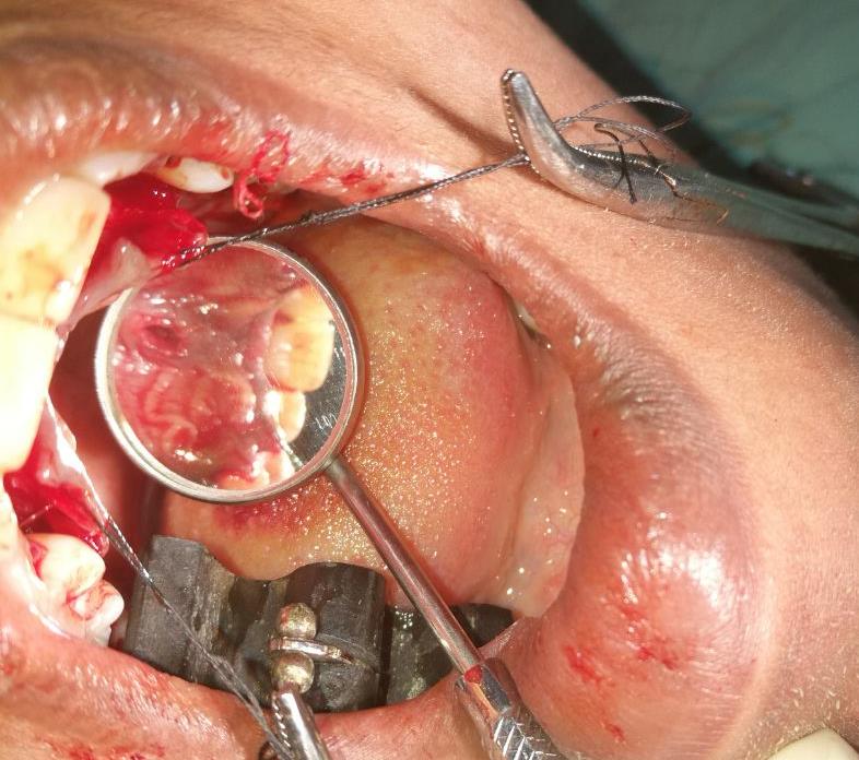 Figure 4: Mucoperiosteal flap reflection of the cyst.