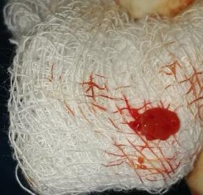 Figure 6: Excised tissue for histopathological examination.