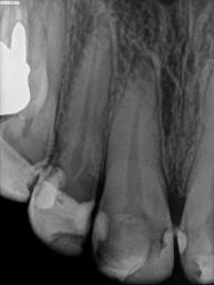 Figure 2: Preoperative periapical x-ray.