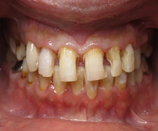Figure 8: Interim crowns.