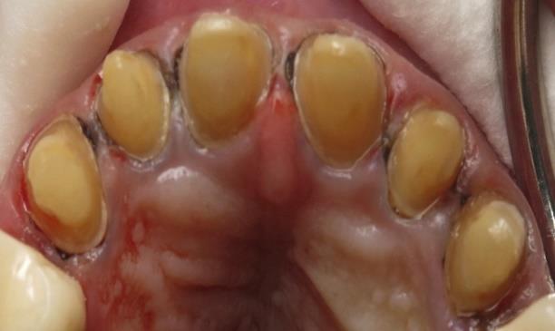 Figure 9: Gingival retraction using impression.