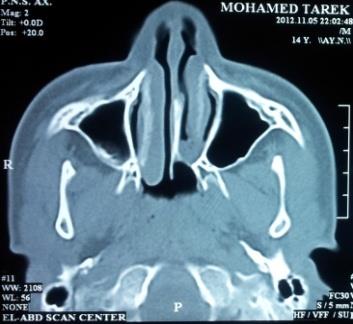 Figure 2: CT bony axial cut demonstrating unilateral mixed choanal atresia.
