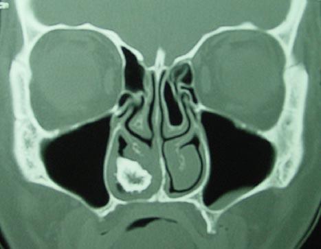 Figure 2: CT scan PNS Showing Rhinolith.