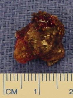 Figure 4: Postoperative specimen of rhinolith.