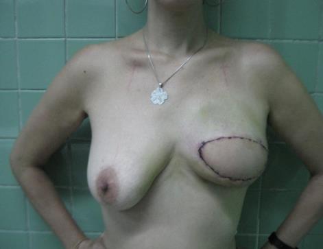 Figure 1: Late postoperative reconstruction of the ANC by contralateral nipple graft and areola tattoo.