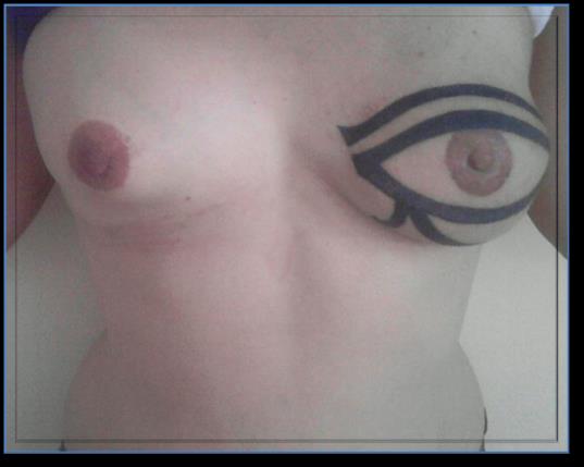 Figure 3: ANC reconstruction with contralateral nipple and areola graft.