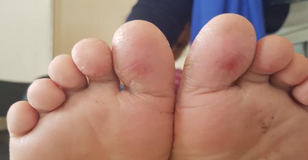 Figure 1: Superficial exfoliation of toes and background erythema.