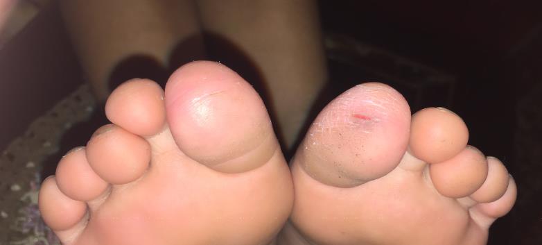Figure 2: Superficial expoliation with fissuration of toes.