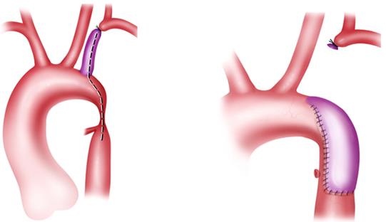Figure 1: Illustration shows end-to-end anastomosis for repair of coarctation of aorta.