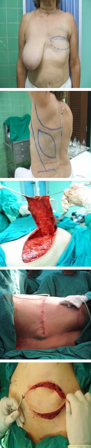 Figure 1: Surgical technique of the dorsal wide muscle-cutaneous flap, plus silicone gel breast implant placement.
