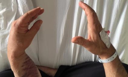 Figure 1: A 55-year-old man with absence of extension of the right index finger, thumb and wrist extension when compared with left.