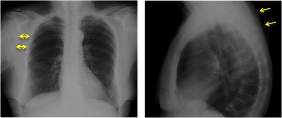 Figure 5: Anterior-posterior x-ray radiography: Increased space between the scapula and the thoracic grid is observed. Thorax lateral radiography: There is an increase in the soft tissue volume at the scapular level associated with elevation of the scapula.