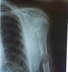 Figure 1: X-ray of the left humerus showing the fracture and associated bone lacunar images.