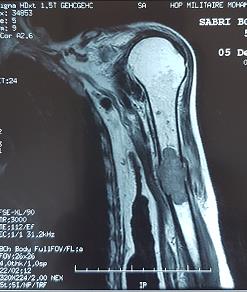 Figure 3: MRI of the left arm shows a fracture on a tumor process.