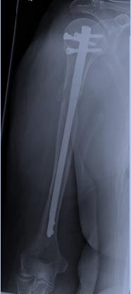 Figure 5: X-ray of the left humerus from the front showing good bone stabilization with a static nail.