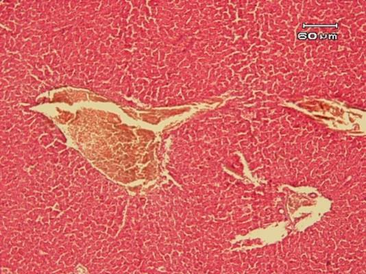 Figure 2: Up left: normal structure of liver; other pictures show the harmful effects of cadmium on the shape of hepatocytes and obvious hemorrhage (Oil red).
