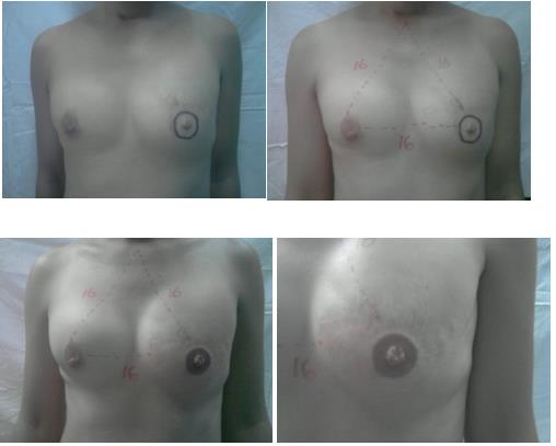 Figure 1: After placement of tissue expander, contralateral autologous nipple graft and areola tattoo is performed.