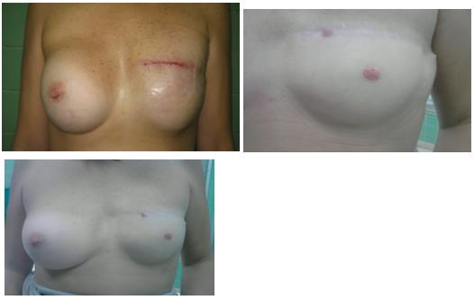 Figure 2: 2nd surgical time with reconstruction of the nipple. Autologous nipple contralateral graft.