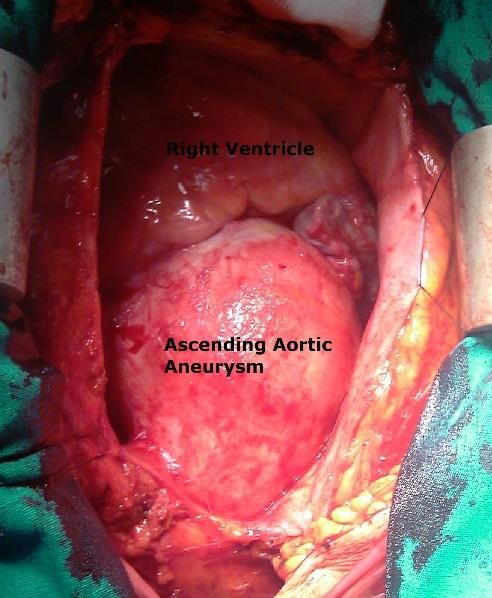 Figure 2: Operative image of a giant ascending aorta (approximately 68 mm).