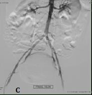 Figure 2: Sagittal (A); Axial (B) and Coronal (C): T2-wieatghed images of the pelvis at the level of the uterus show abnormal hypo intense focus/flow void along the anterior upper endometrial cavity that extend into the myometrial (white arrow in A, B and C). Note the retroverted retroflexed uterus.