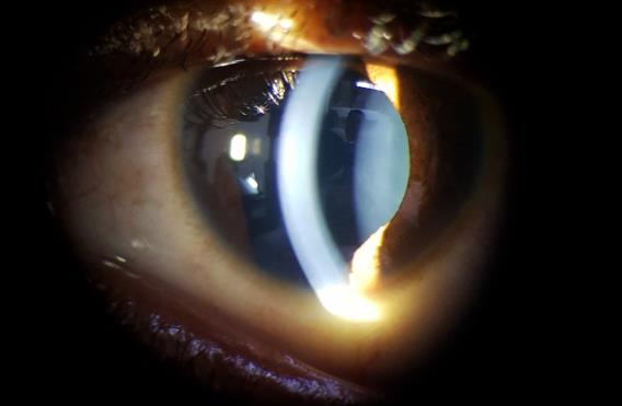 Figure 1: Iris Coloboma with Cataractous Lens.