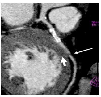 Figure 10: Multiplanar reformat cross-section of the stent lumen showing the low attenuated neointimal hyperplasia causing a moderate stenosis of the stent (arrow). A contiguous section of the same stent distally shows the normal lumen (thick arrow).