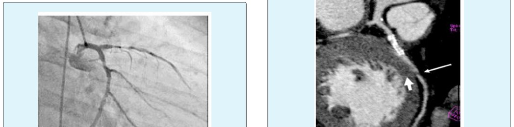 Figure 11: Angiogram showing the moderate LAD stent.