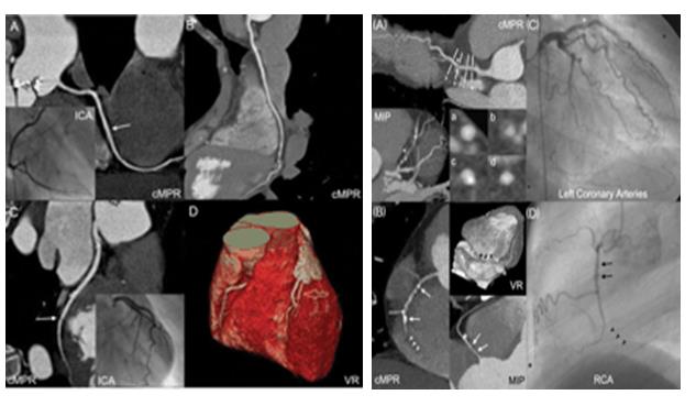Figure 14: Showing normal images of CABG patients of both modalities CTA & Angiography.