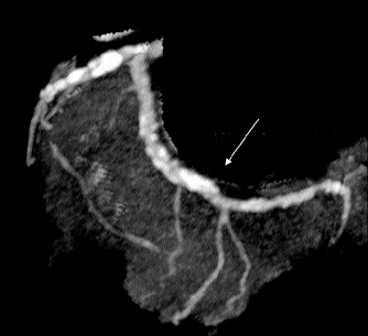 Figure 4: Interpretation: Table 1 & Figure 4 shows that out of a total of 62 patients, 29 patients (46.8%) had CACS from 0 -100, 8 patients(13%) have CACS more than 300,15 patients (24%) are post –stenting, and 10 patients(16%) were post CABG.