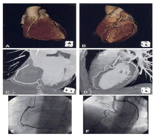 Figure 7: Which showing 3D SSD images & MIP images of upper two rows & lower row showing the images of same patient of Angiography RCA & LAD arteries.