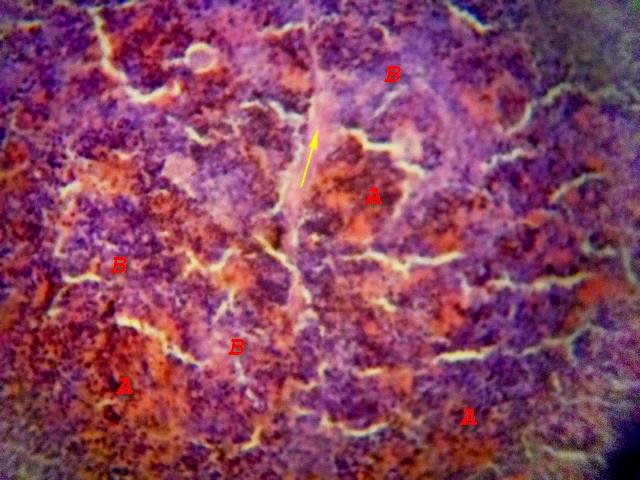 Figure 4: Photomicrograph of Camel Spleen showing clearly zones of white pulp (A) and Red pulp (B) cells with developed inter-paranchymal traberculae collagen connective tissue fibers (Yellow arrow) H&E x200.
