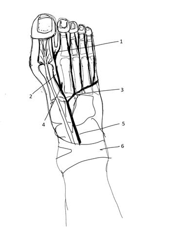 Figure 1: Vascular Basis of the Flap. (1) Perforator from Distal Communicating Artery, (2) 1st Dorsal Metatarsal Artery, (3) Arcuate Artery (4) Deep Plantar Branch, () Dorsalis Pedis Artery, (6) Extensor Retinaculum