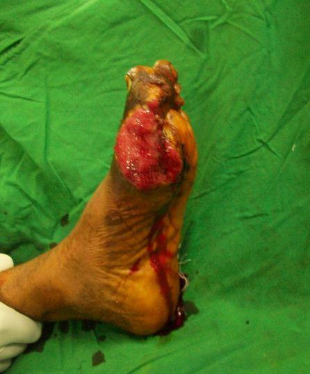 Figure 2: Figure showing defect in distal left foot and great toe of case 1.