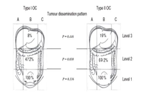 Figure 2: Intraoperative pattern of spread between Type I & II EOC.