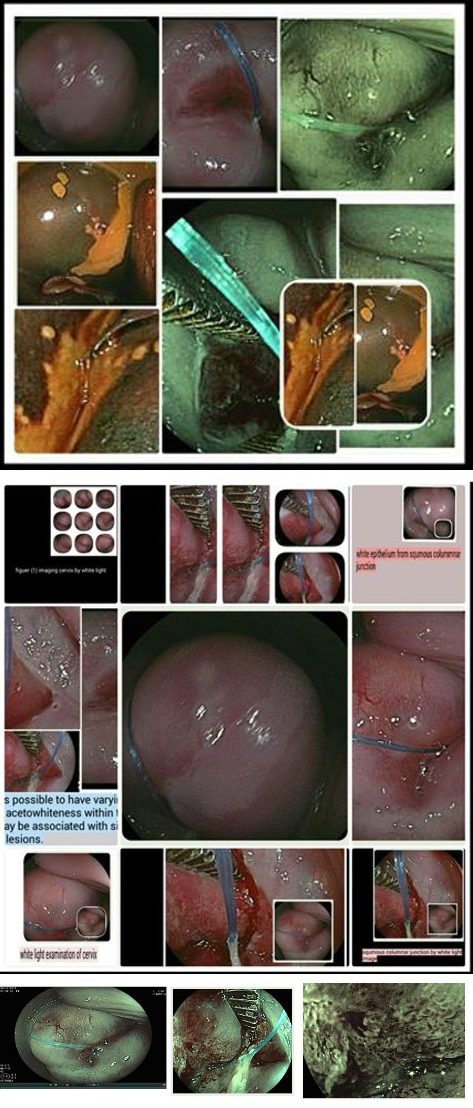 Figure 1: CIN1the site and the character in different image on the exocervix in first image, in squamous columnar junction in second image.