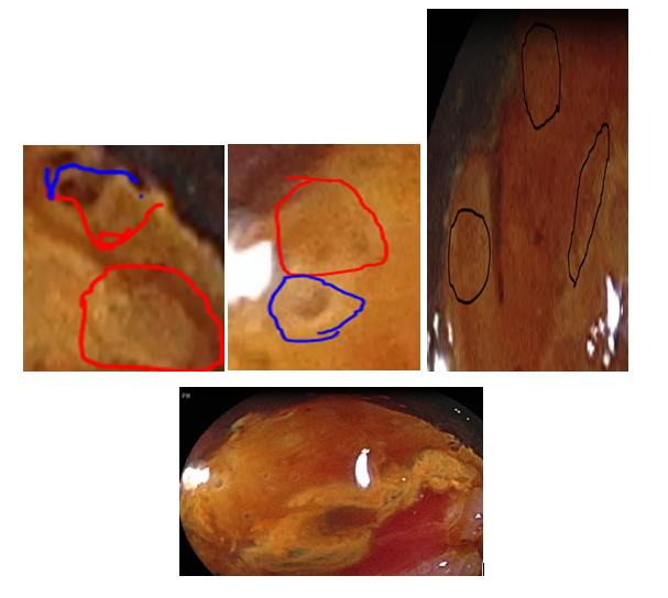 Figure 12: Red circle immature squamous cells, reveres cells blue circle, Blue line reveres cells, immature metaplasia red line.