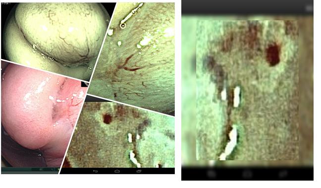 Figure 13: Immature metaplasia black line.