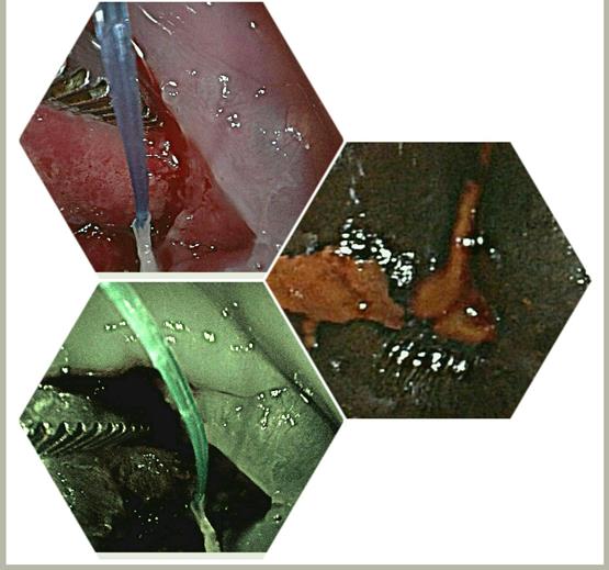 Figure 8: Area of metapastic cells with evidence from above down area of columnar cells and immature dysplastic cells in different stage.
