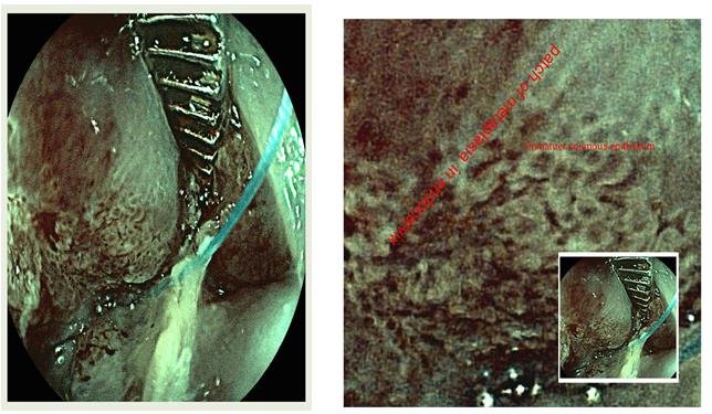 Figure 9: Reserve cells at squamous columnar junction which is cuboid in shape uniform in shape and round nucleoid to by different from dysplastic cells.