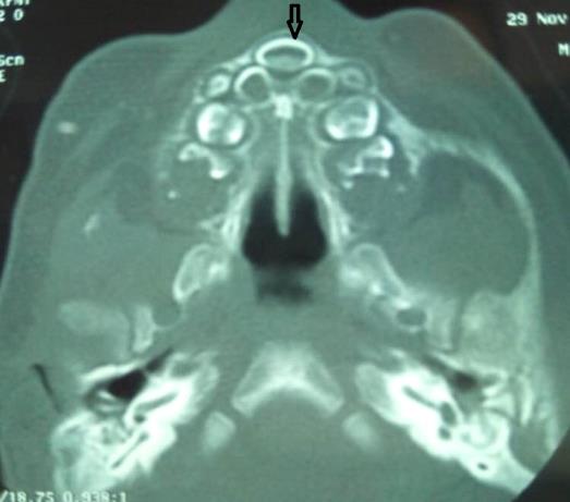 Figure 2: Axial CT scan shows an unerupted single central maxillary megaincisor (arrow).