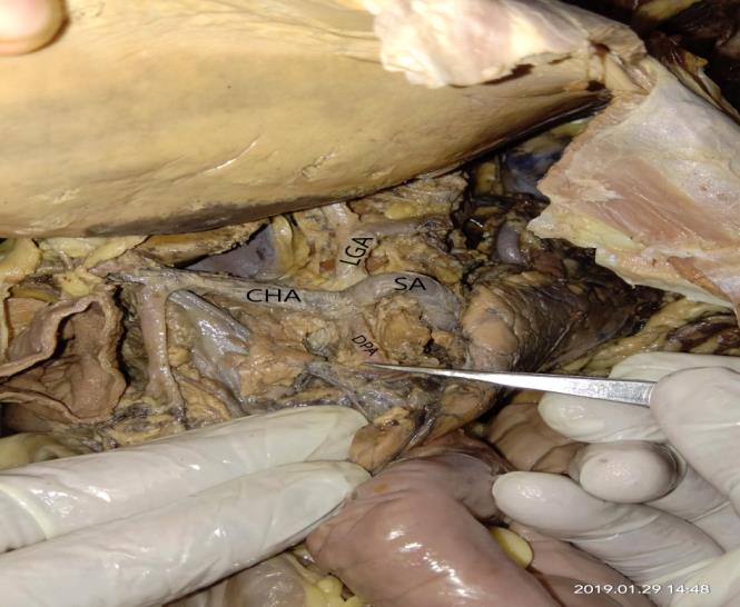 Figure 1: Coeliac trunk tetrafurcation (CHA-Common hepatic artery, LGA-left gastric artery, SA-splenic artery, DPA- Dorsal pancreatic artery)