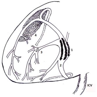 Figure 1: Diagrammatic representation demonstrating various types of iatrogenic injuries to the coronary sinus and its tributaries- (1) high pressure blow out rupture of the coronary sinus, (2) proximal injuries secondary to various causes, (3) distal rupture (perforation of the coronary sinus, and/or its radicals of the right ventricle), (4) hematoma without perforations in the atrioventricular groove. (ICV- Inferior caval vein) Proximal injuries: Proximal injuries are mainly due to direct perforation of the coronary sinus catheter tip with stylet in situ, catheter misplacement or displacement, electrodes used during biventricular facing and misdirected venous cannula while performing minimally invasive procedures. Malpositioning of the specially designed catheters, often predisposes to a subsequent dislodgement or iatrogenic injuries (Figure 1).