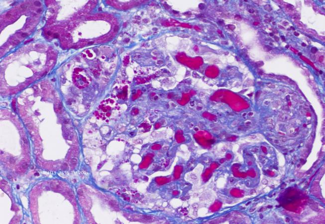 Figure 2: Renal biopsy.