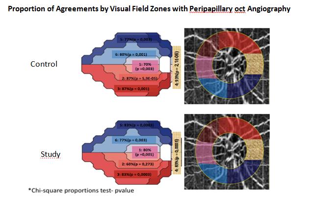 Figure 4: Agreements of proportions of visual field zones, with the corresponding peripapillary region of OCT-A.