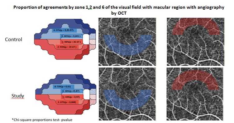Figure 5: Agreements of proportions of visual field zones, with corresponding macular region of OCT-A.