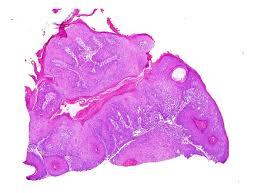 Figure 1: Squamous eddies, basaloid aggregates and follicular pattern in inverted follicular keratosis [11].