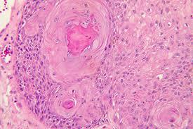 Figure 11: Squamous eddies and aberrant keratinocytes in inverted follicular keratosis [17].