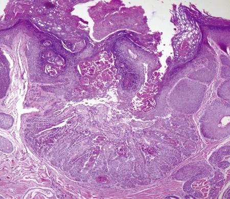 Figure 2: Basaloid aggregates, acanthotic, hyperkeratotic epithelium and perifollicular inflammation in inverted follicular keratosis [12].