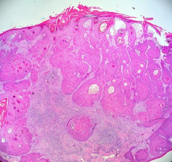 Figure 3: Follicular dissemination of basaloid cells with perifollicular inflammatory clusters in inverted follicular keratosis [13].
