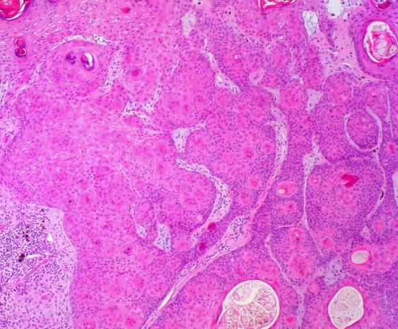 Figure 4: Squamous eddies, follicular configuration and dykeratotic epithelium in inverted follicular keratosis [13].